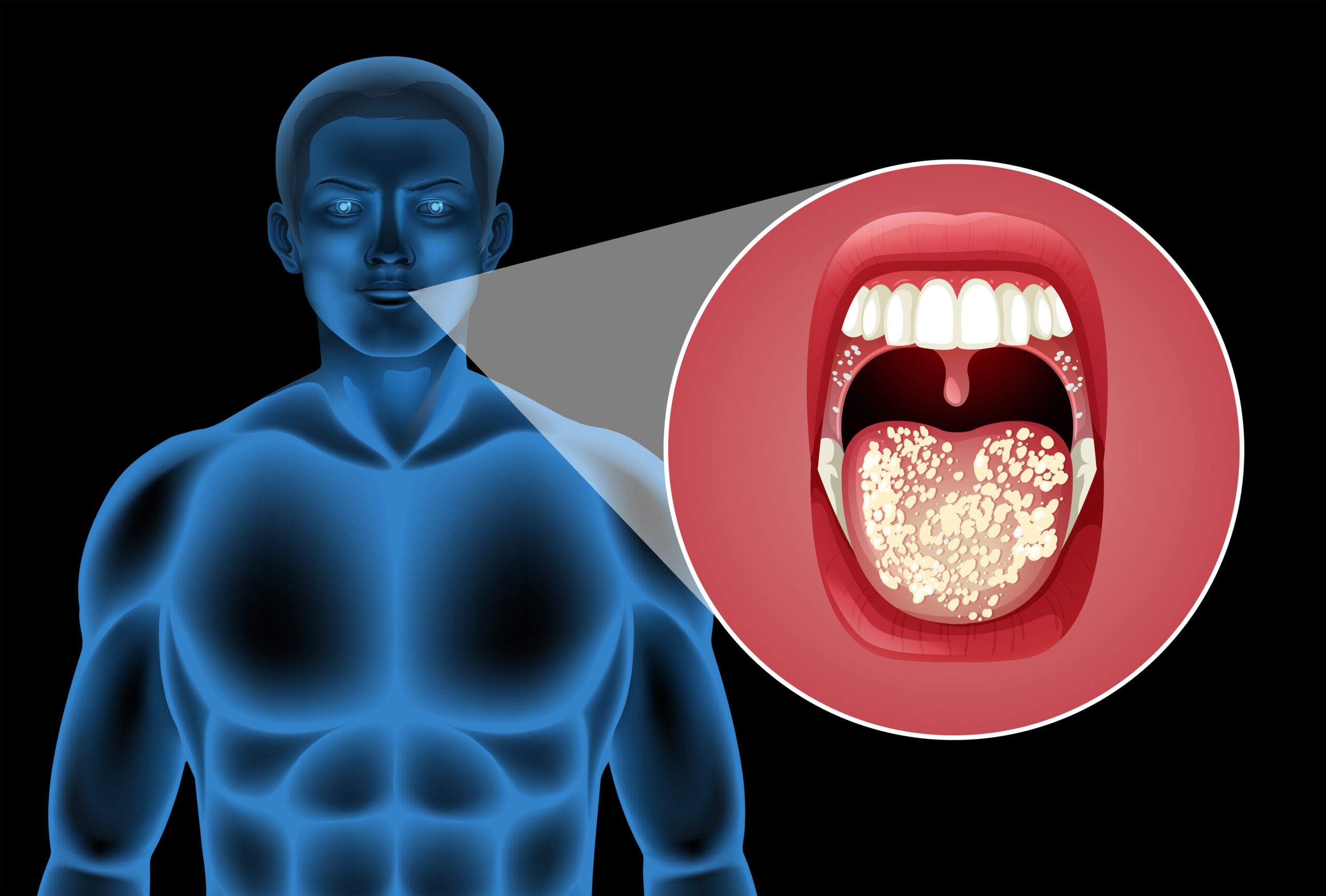 Medical illustration showing oral cancer in the mouth