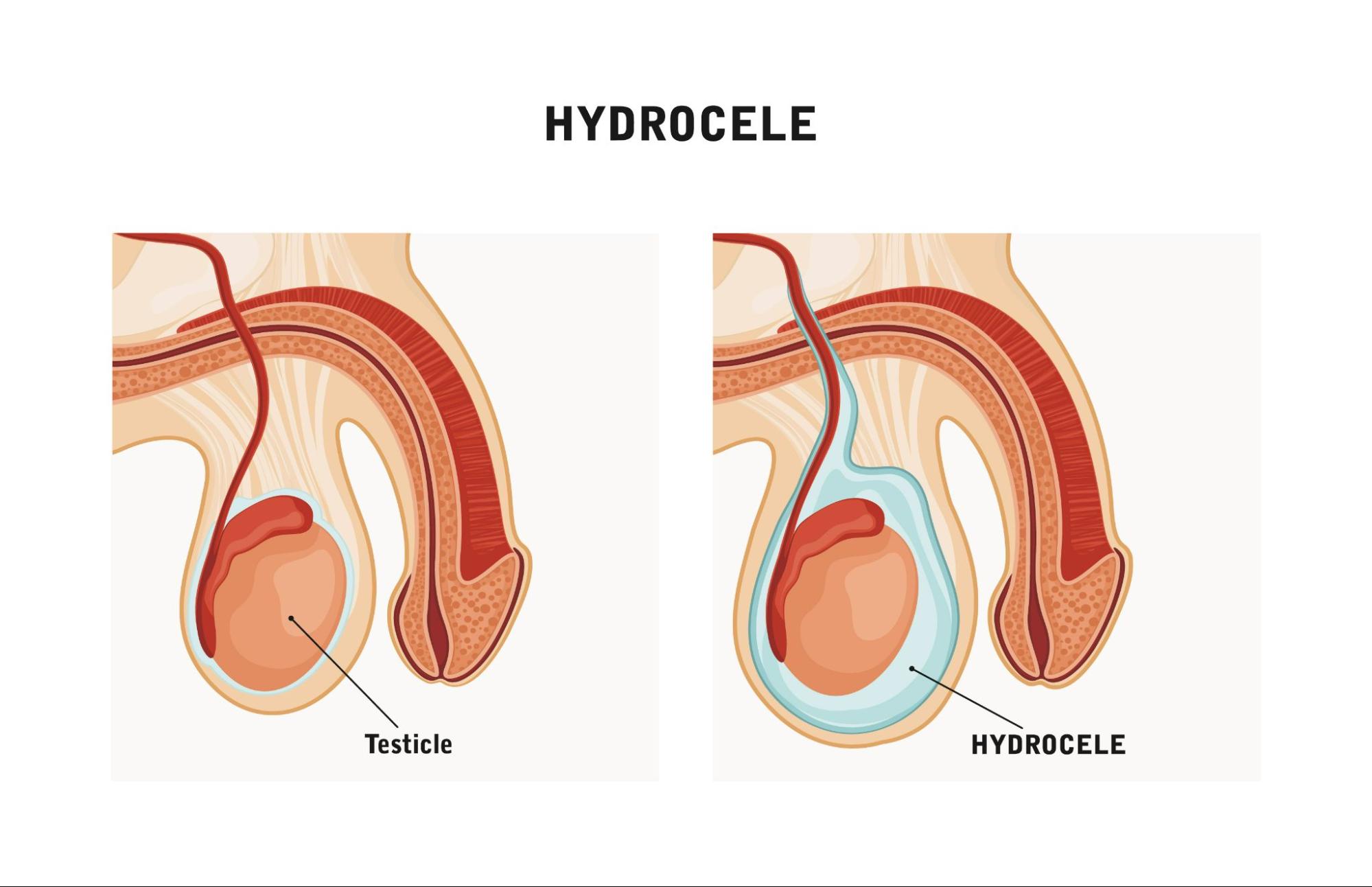 Hydrocele Surgery
