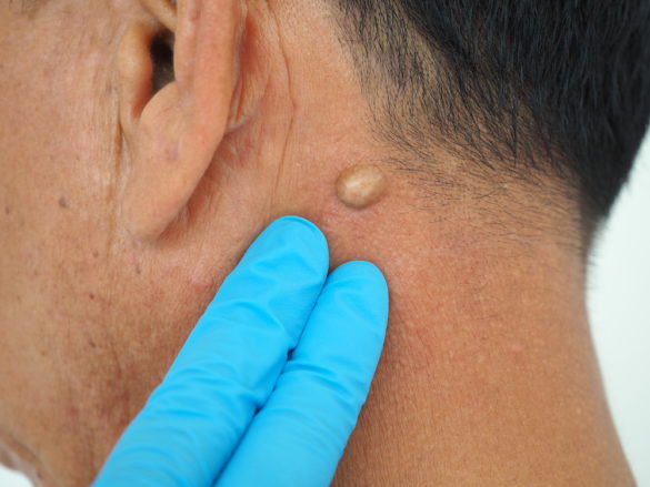 Sebaceous Cyst